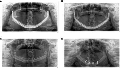 Antiresorptive agents enhance ossification of free flap reconstructions of the mandible: a radiological retrospective cohort study